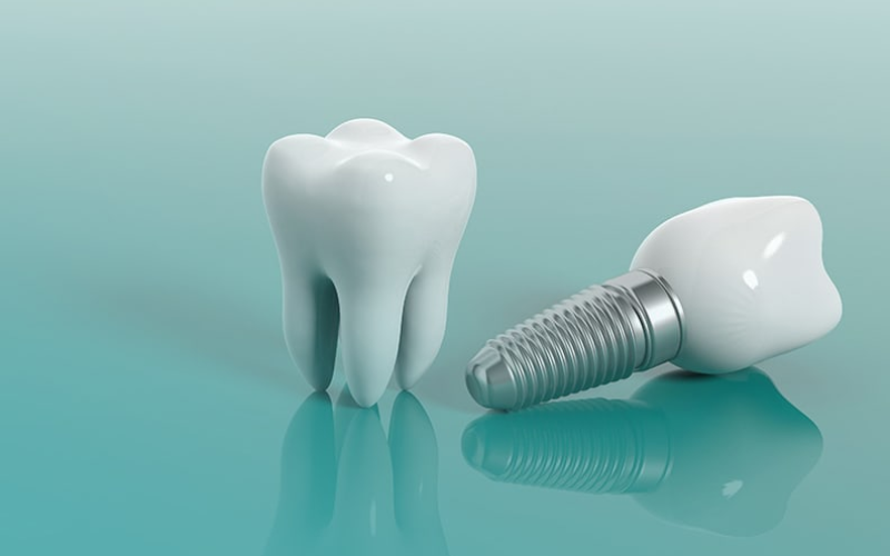 Getting Dental Implants
