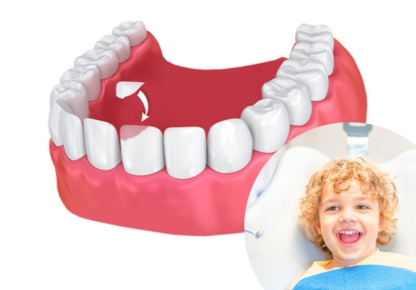 Dental Bonding For Children