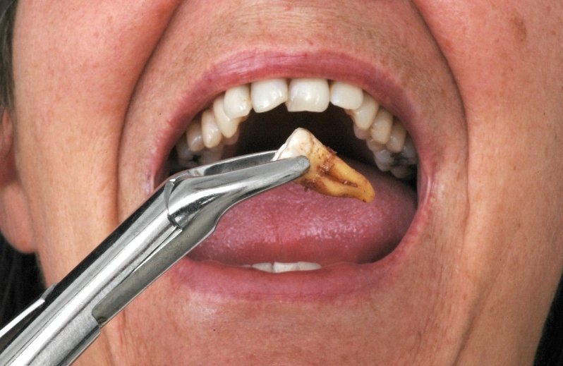 tooth extraction aftercare tips for a speedy recovery