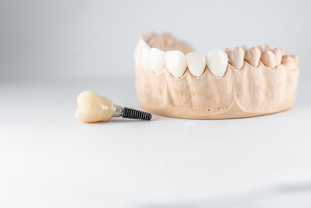 Dental Implants in South Houston